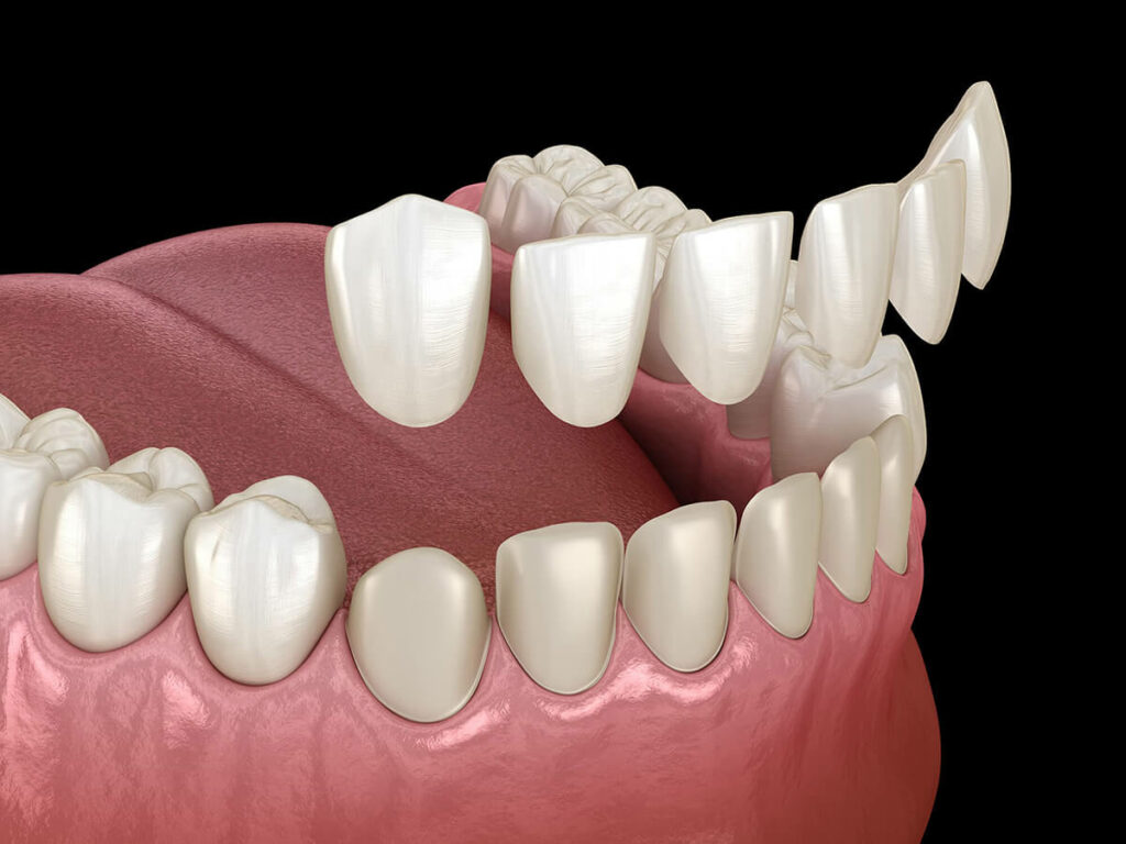 illustration of dental veneers