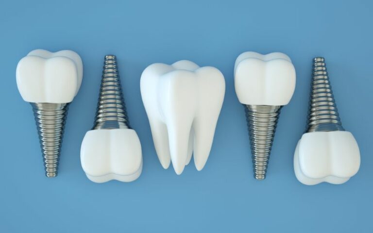 illustration of dental implants on a blue background