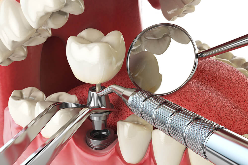 illustration of dental implant with dental tools