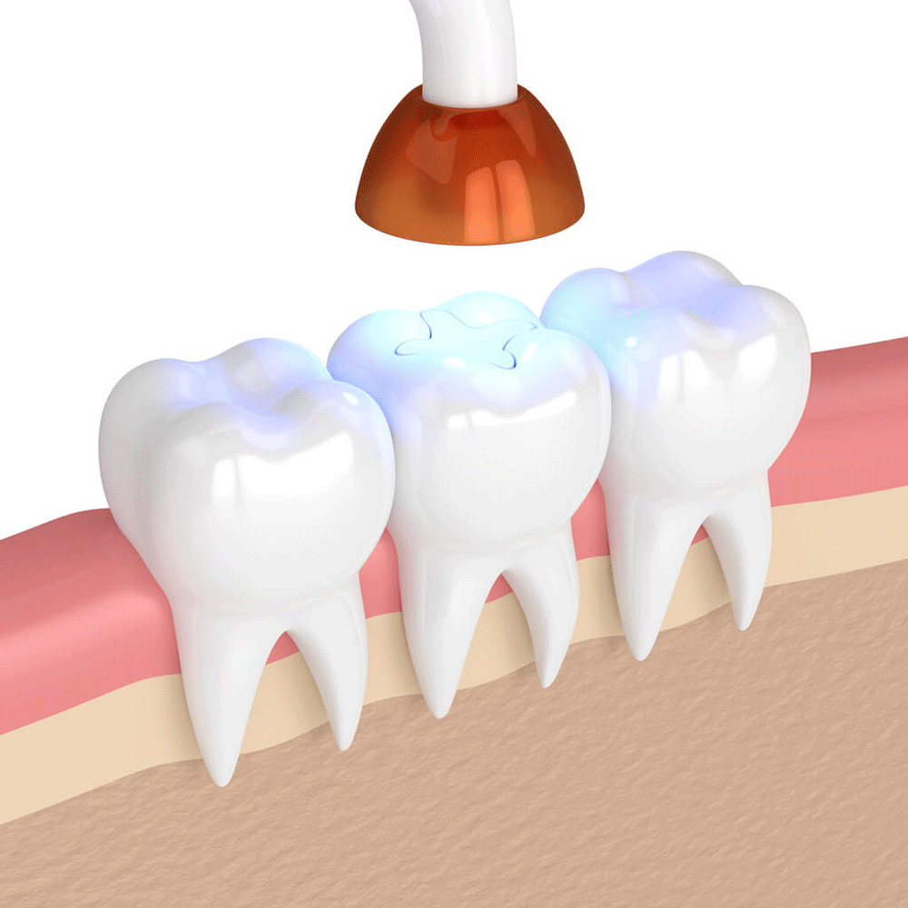 illustration of a tooth filling being sealed